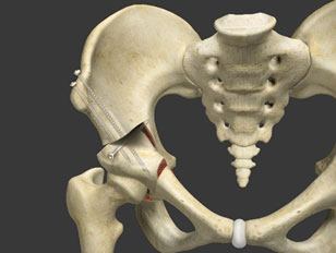 Periacetabular (Ganz) Osteotomy